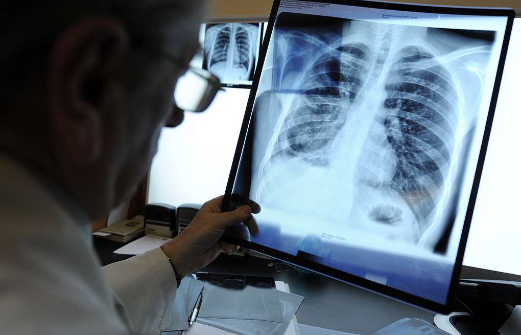 За год в Карелии у 130 человек обнаружили туберкулез 