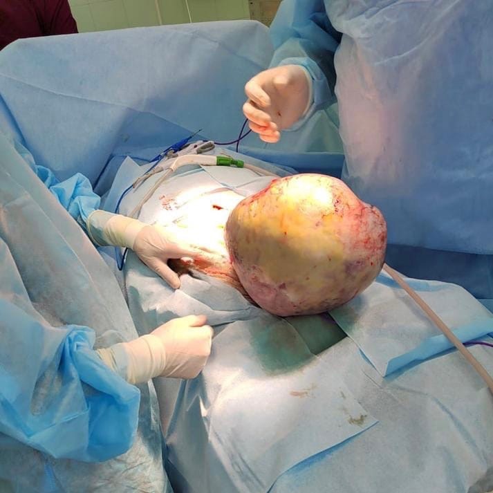 В Карелии врачи спасли молодую женщину с шестикилограммовой опухолью в животе