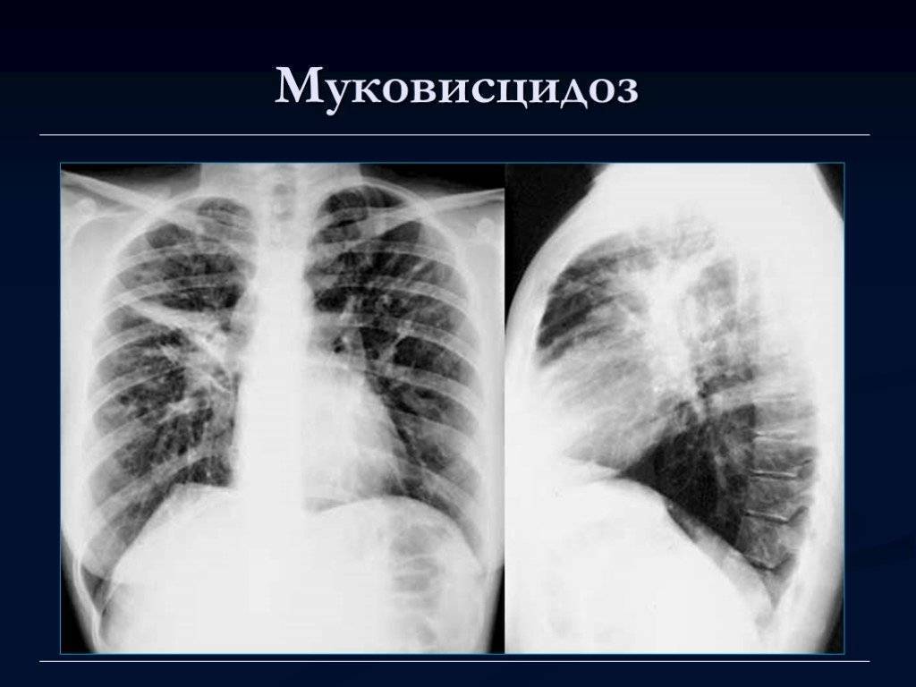 Фиброз у детей. Муковисцидоз лёгочная респираторная форма. Муковисцидоз легочная форма проявления. Муковисцидоз у детей рентген.