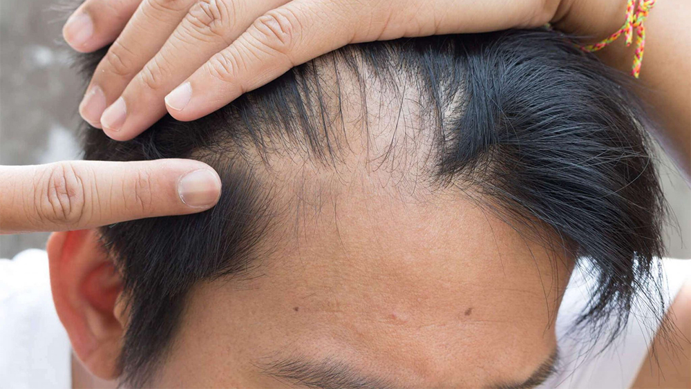 Глава Минздрава Карелии перечислил причины выпадения волос